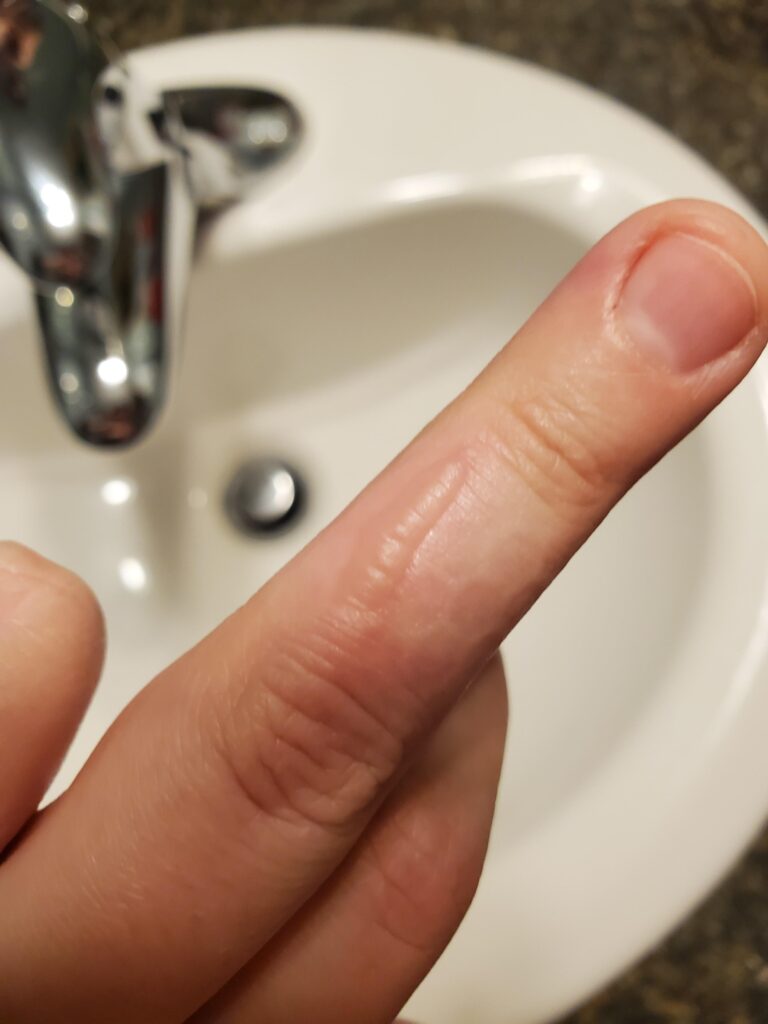 Hot Glue Gun Burn Blister