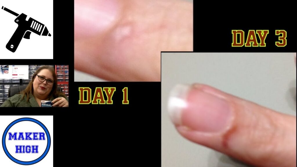 How To Treat A Glue Gun Burn What To Do When You Burn Yourself With A Hot Glue Gun YouTube